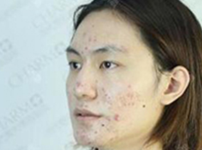 日志—祛痘好方法？看看美男怎么祛痘的！